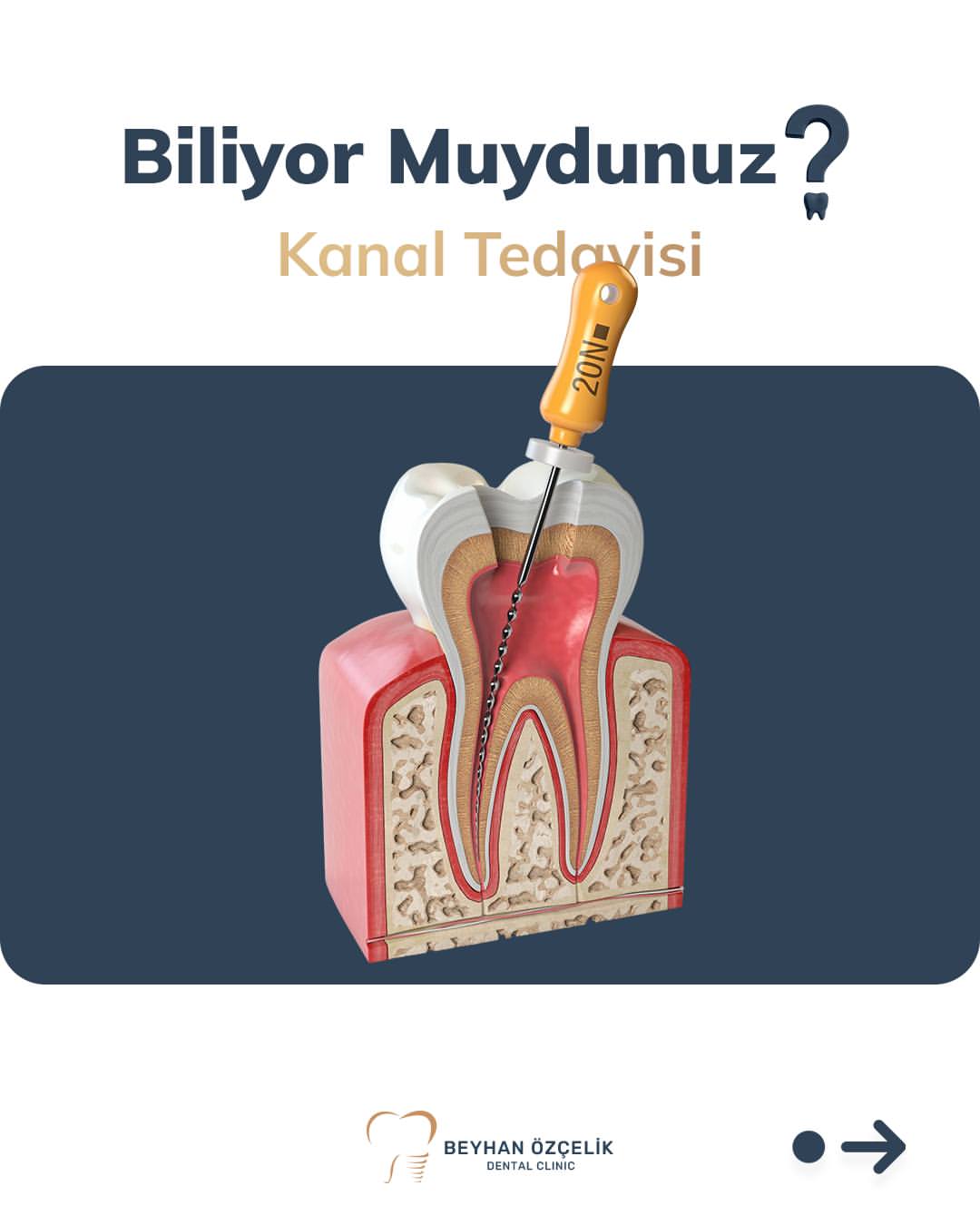 Kanal Tedavisi: Enfekte Dişleri Çekmeden Kurtarmanın Yolu
