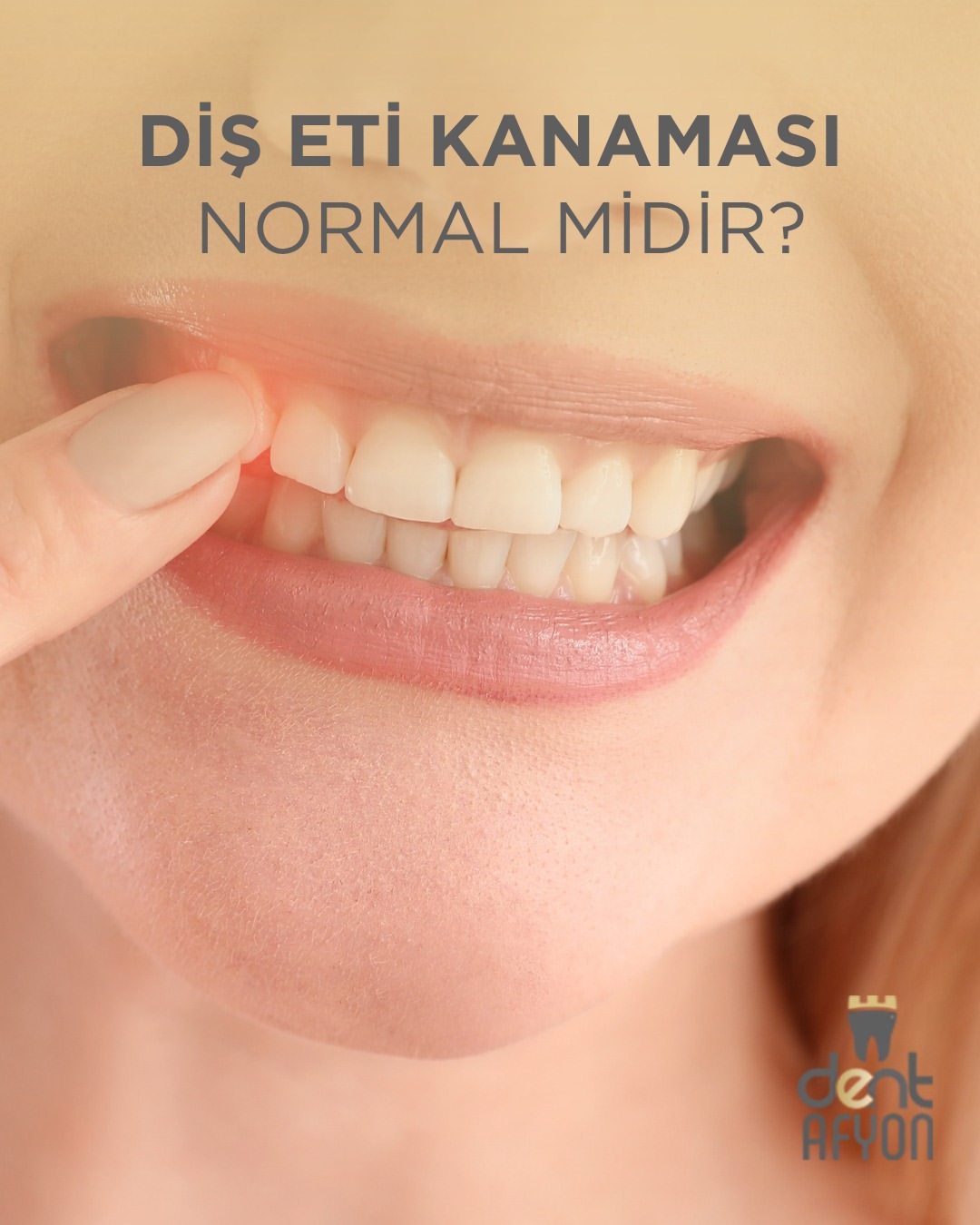 Diş Eti Kanaması Şikayetiyle Dikkat! Sağlığınız İçin Erken Teşhis Önemli