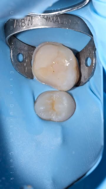 Çocuklarda Kalıcı Dişlerde İleri Seviye Çürük Tedavisi: Estetik ve Fonksiyonel Çözüm