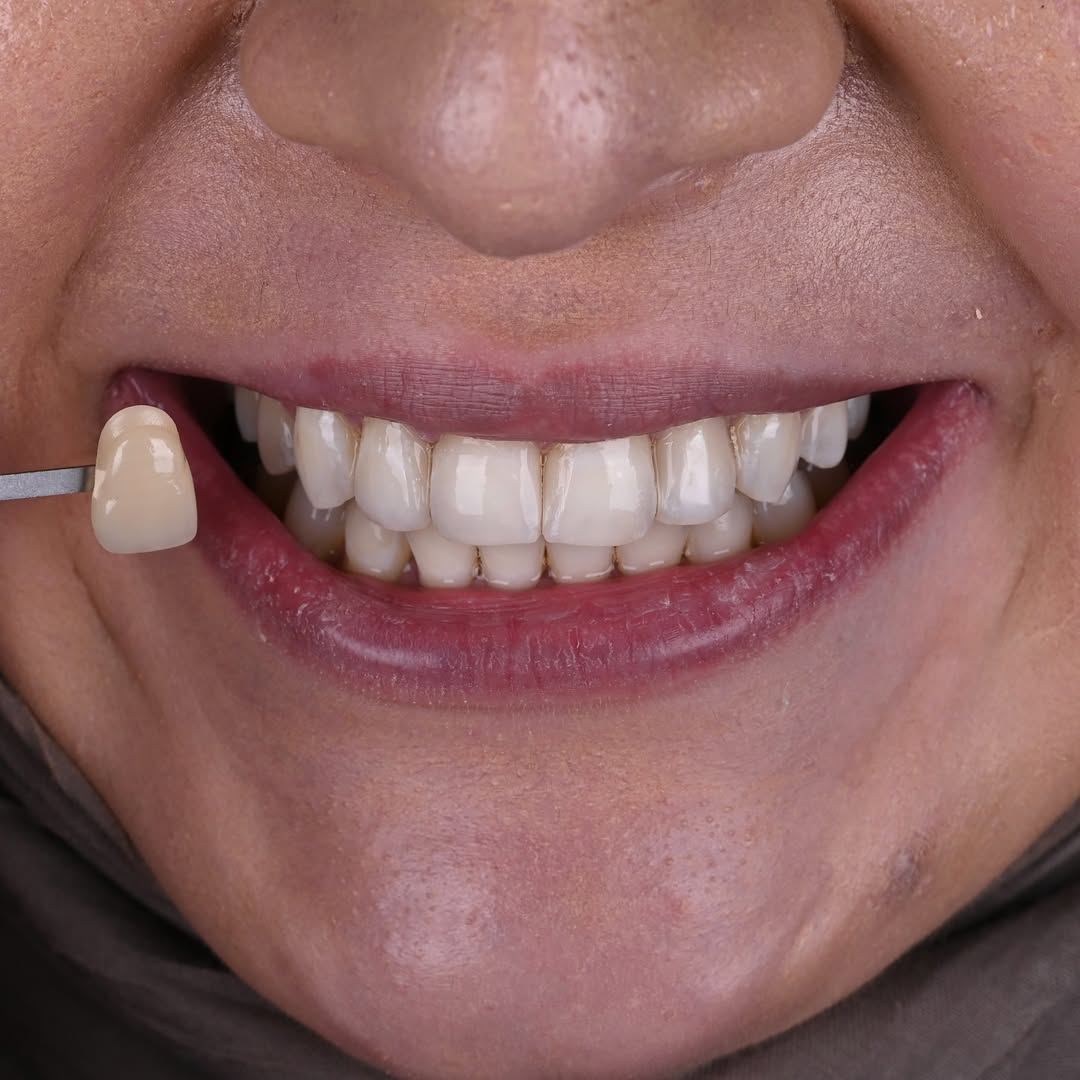 Diş Beyazlatma ve Estetik Dolgu ile Özgüvenli Gülümseme