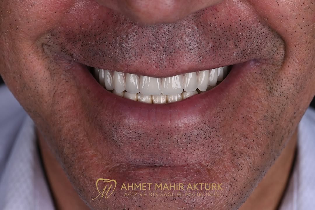 Üst Total Protez Uygulamasıyla Hastanın Konforu Artırıldı